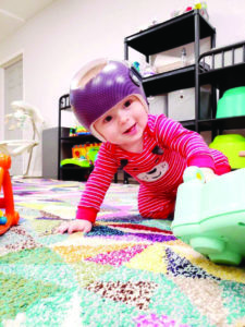 Plagiocephaly