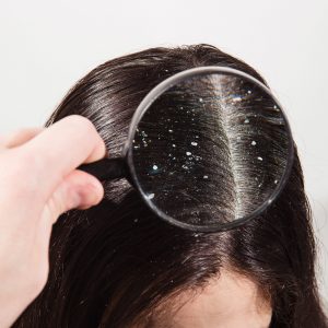 magnifying glass looking at girl with dandruff