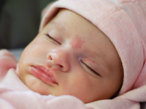 Baby with birthmark